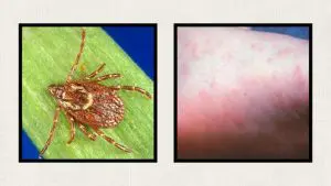 tick-dog-tick-spotted-fever-bite