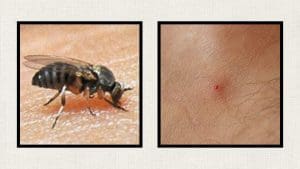 blackfly-bite