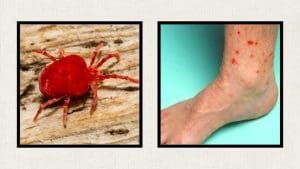 chigger-bites