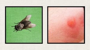 horsefly-bite