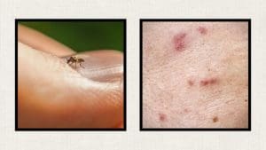 no-see-ums-sandfly-bites